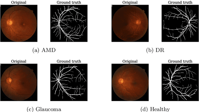 Figure 2 for Explainable Convolutional Neural Networks for Retinal Fundus Classification and Cutting-Edge Segmentation Models for Retinal Blood Vessels from Fundus Images