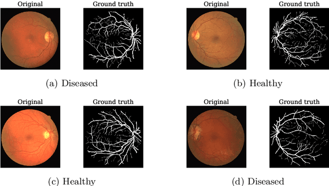 Figure 4 for Explainable Convolutional Neural Networks for Retinal Fundus Classification and Cutting-Edge Segmentation Models for Retinal Blood Vessels from Fundus Images