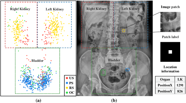 Figure 3 for Location embedding based pairwise distance learning for fine-grained diagnosis of urinary stones