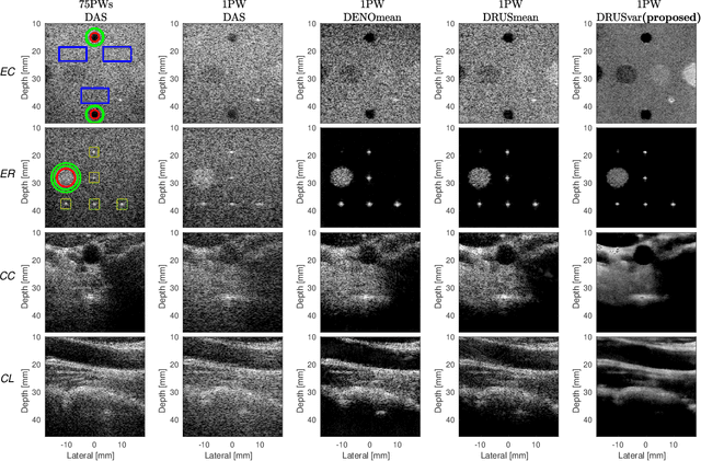 Figure 4 for Ultrasound Imaging based on the Variance of a Diffusion Restoration Model