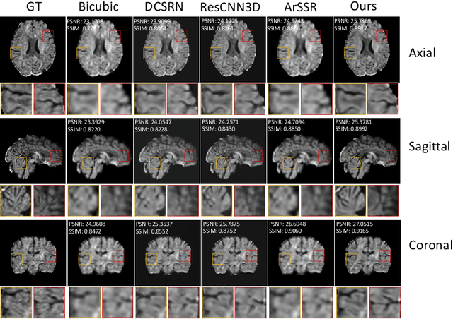Figure 3 for CSR-dMRI: Continuous Super-Resolution of Diffusion MRI with Anatomical Structure-assisted Implicit Neural Representation Learning