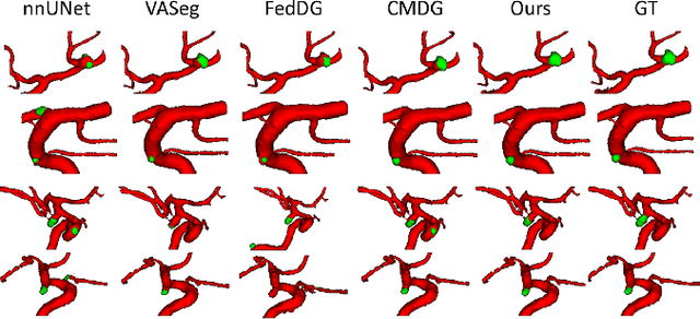 Figure 4 for GS-EMA: Integrating Gradient Surgery Exponential Moving Average with Boundary-Aware Contrastive Learning for Enhanced Domain Generalization in Aneurysm Segmentation