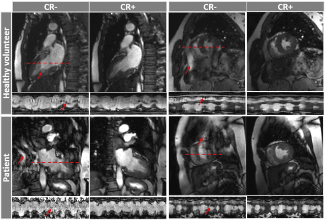 Figure 3 for Coil Reweighting to Suppress Motion Artifacts in Real-Time Exercise Cine Imaging