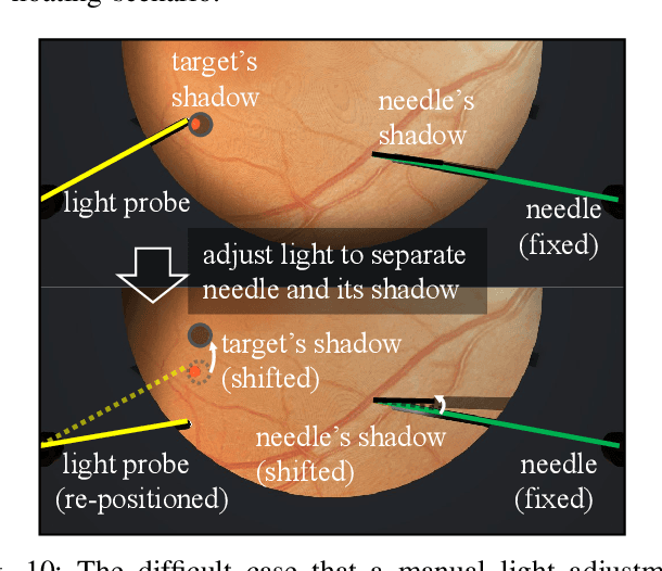 Figure 2 for EyeLS: Shadow-Guided Instrument Landing System for Intraocular Target Approaching in Robotic Eye Surgery