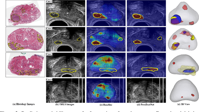 Figure 3 for ProsDectNet: Bridging the Gap in Prostate Cancer Detection via Transrectal B-mode Ultrasound Imaging