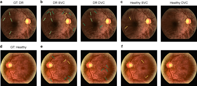 Figure 4 for Generating Realistic Counterfactuals for Retinal Fundus and OCT Images using Diffusion Models