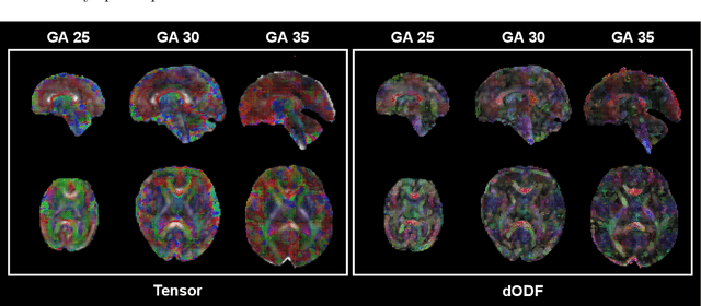 Figure 3 for Anatomically Constrained Tractography of the Fetal Brain