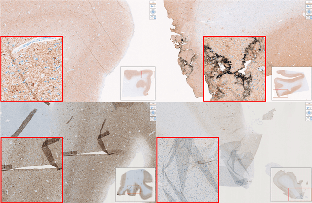 Figure 4 for Computational Pathology for Brain Disorders