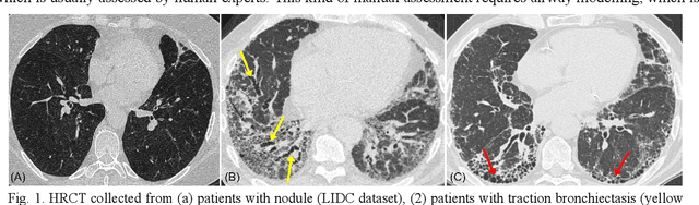 Figure 1 for Hunting imaging biomarkers in pulmonary fibrosis: Benchmarks of the AIIB23 challenge