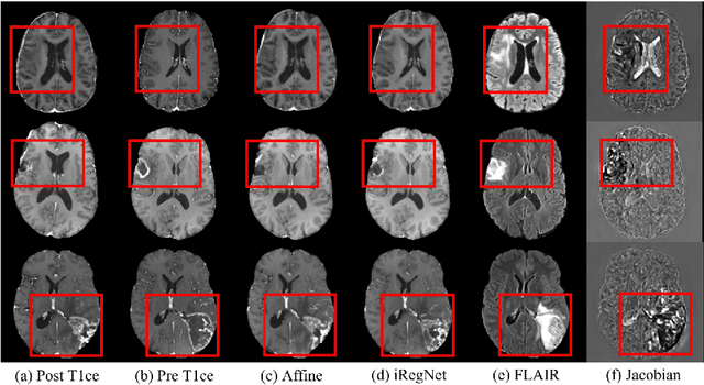 Figure 3 for Self-supervised iRegNet for the Registration of Longitudinal Brain MRI of Diffuse Glioma Patients