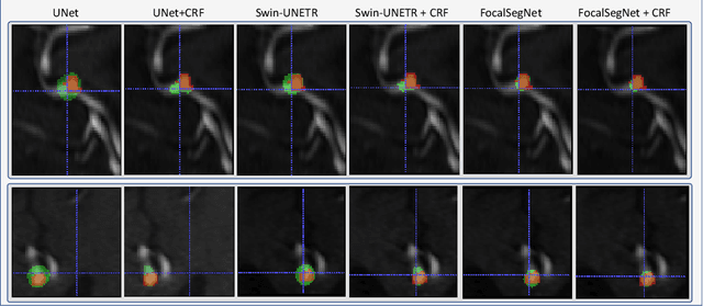 Figure 4 for Weakly supervised segmentation of intracranial aneurysms using a 3D focal modulation UNet
