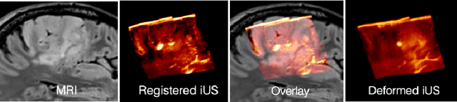 Figure 1 for FocalErrorNet: Uncertainty-aware focal modulation network for inter-modal registration error estimation in ultrasound-guided neurosurgery