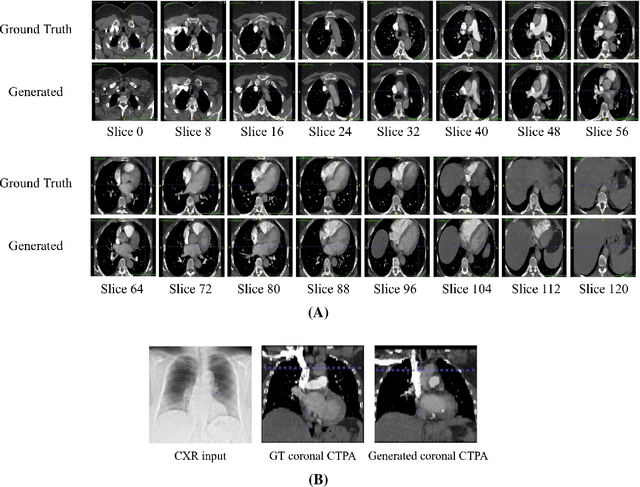 Figure 3 for X-ray2CTPA: Generating 3D CTPA scans from 2D X-ray conditioning