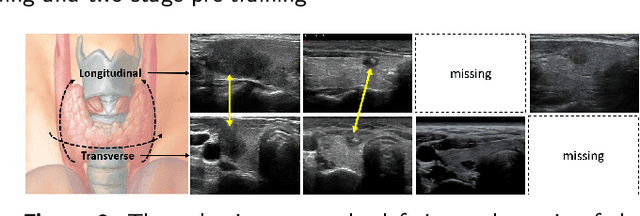 Figure 3 for Thyroid ultrasound diagnosis improvement via multi-view self-supervised learning and two-stage pre-training