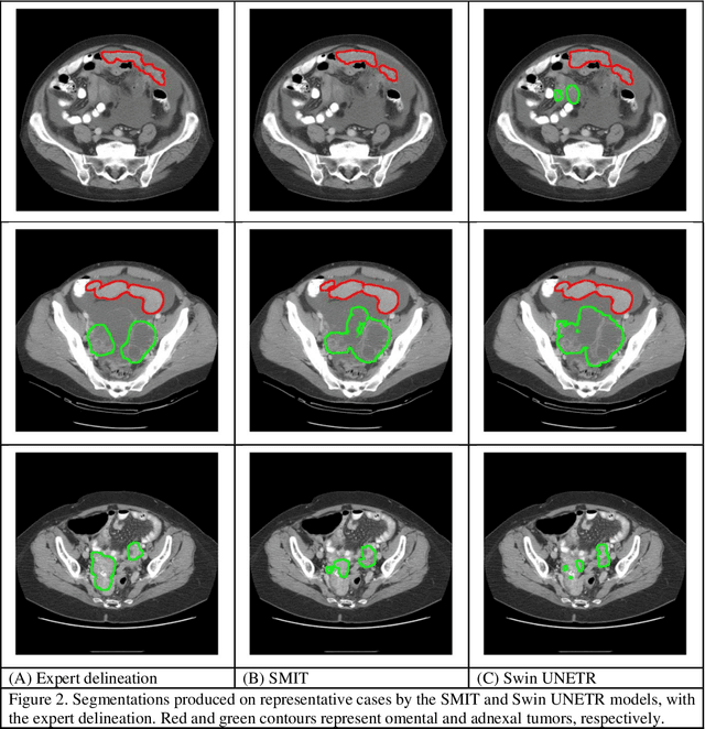 Figure 4 for Transformer-based segmentation of adnexal lesions and ovarian implants in CT images