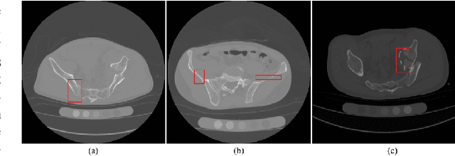 Figure 1 for Towards Cross-Scale Attention and Surface Supervision for Fractured Bone Segmentation in CT
