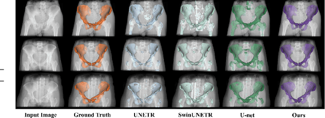 Figure 4 for Towards Cross-Scale Attention and Surface Supervision for Fractured Bone Segmentation in CT