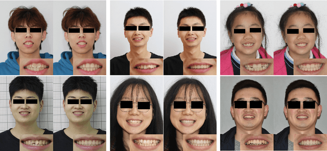 Figure 1 for 3D Structure-guided Network for Tooth Alignment in 2D Photograph