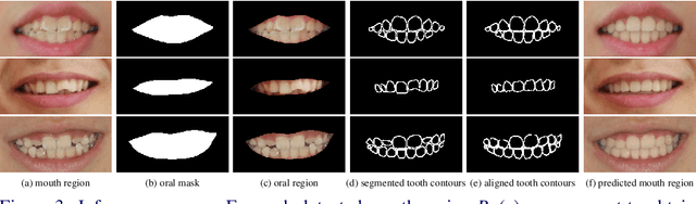 Figure 4 for 3D Structure-guided Network for Tooth Alignment in 2D Photograph