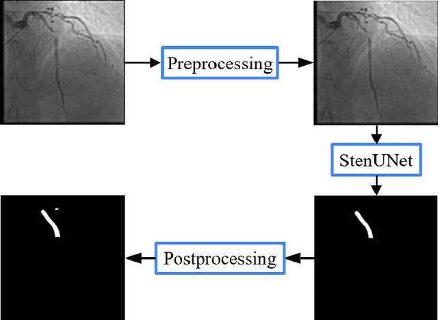 Figure 1 for StenUNet: Automatic Stenosis Detection from X-ray Coronary Angiography