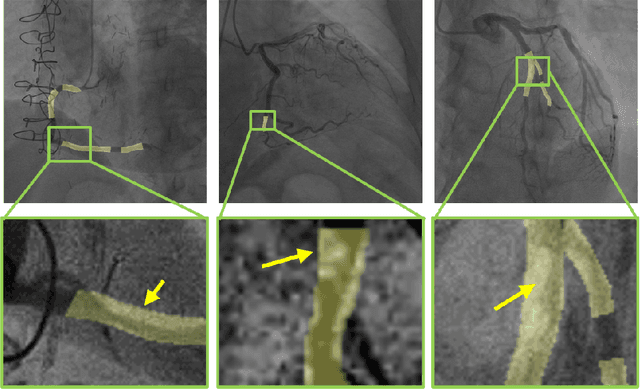 Figure 3 for StenUNet: Automatic Stenosis Detection from X-ray Coronary Angiography