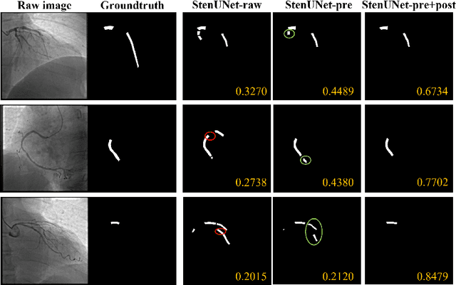 Figure 4 for StenUNet: Automatic Stenosis Detection from X-ray Coronary Angiography