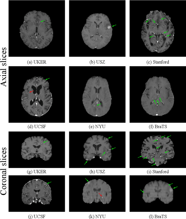 Figure 2 for Multicenter Privacy-Preserving Model Training for Deep Learning Brain Metastases Autosegmentation