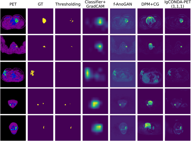 Figure 3 for IgCONDA-PET: Implicitly-Guided Counterfactual Diffusion for Detecting Anomalies in PET Images