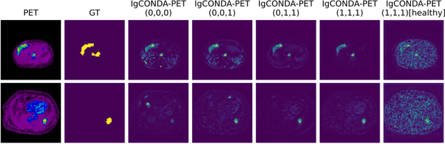 Figure 4 for IgCONDA-PET: Implicitly-Guided Counterfactual Diffusion for Detecting Anomalies in PET Images