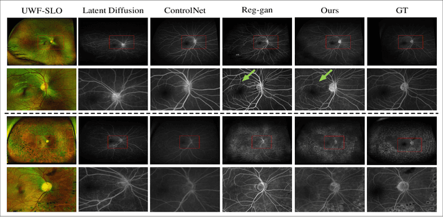 Figure 3 for UWAFA-GAN: Ultra-Wide-Angle Fluorescein Angiography Transformation via Multi-scale Generation and Registration Enhancement