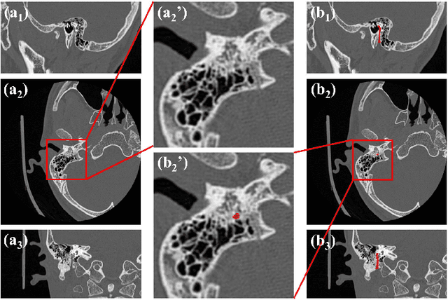 Figure 3 for UADSN: Uncertainty-Aware Dual-Stream Network for Facial Nerve Segmentation