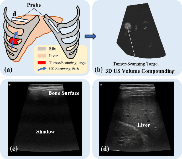 Figure 1 for Autonomous Path Planning for Intercostal Robotic Ultrasound Imaging Using Reinforcement Learning