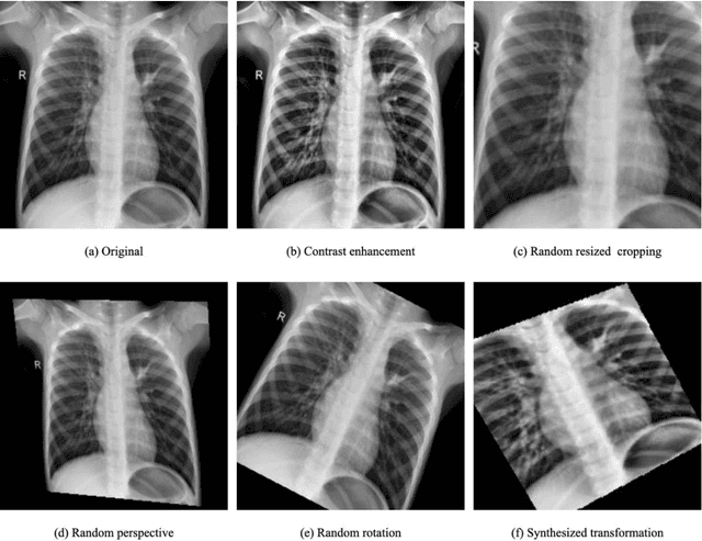 Figure 2 for Pneumonia App: a mobile application for efficient pediatric pneumonia diagnosis using explainable convolutional neural networks (CNN)