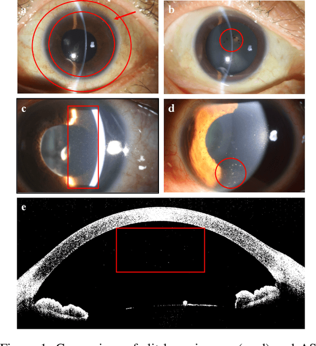 Figure 1 for Jointly Explicit and Implicit Cross-Modal Interaction Network for Anterior Chamber Inflammation Diagnosis