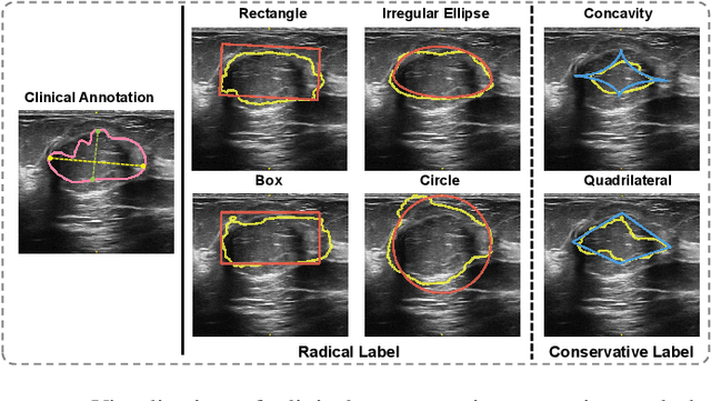 Figure 1 for Ultrasound Nodule Segmentation Using Asymmetric Learning with Simple Clinical Annotation