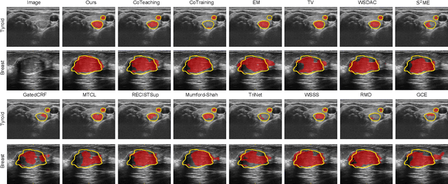 Figure 4 for Ultrasound Nodule Segmentation Using Asymmetric Learning with Simple Clinical Annotation