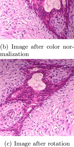 Figure 4 for Breast Cancer Image Classification Method Based on Deep Transfer Learning