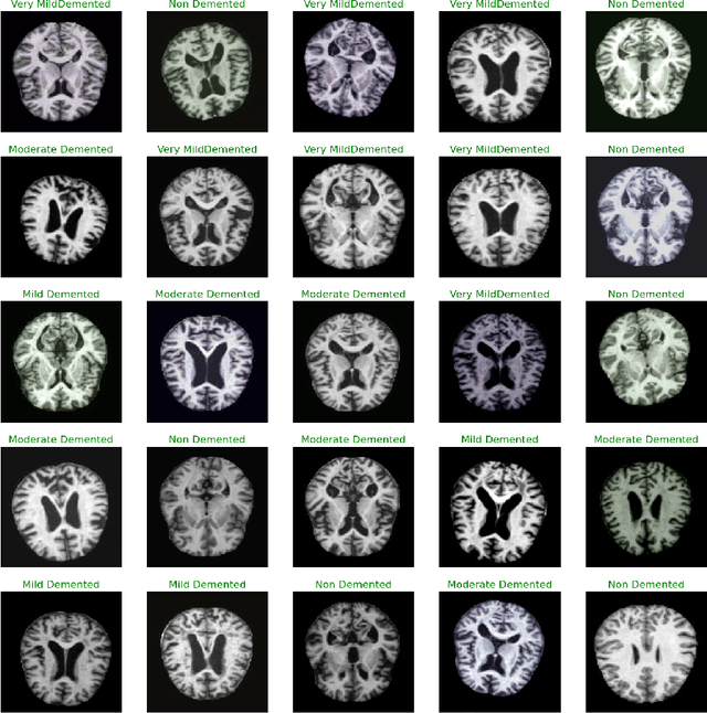 Figure 1 for Leveraging Deep Learning and Xception Architecture for High-Accuracy MRI Classification in Alzheimer Diagnosis