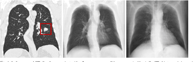 Figure 1 for Nodule detection and generation on chest X-rays: NODE21 Challenge