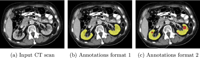 Figure 2 for Kidney abnormality segmentation in thorax-abdomen CT scans