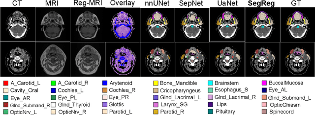 Figure 2 for SegReg: Segmenting OARs by Registering MR Images and CT Annotations