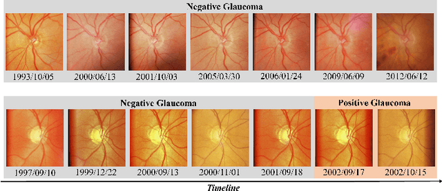 Figure 1 for Multi-scale Spatio-temporal Transformer-based Imbalanced Longitudinal Learning for Glaucoma Forecasting from Irregular Time Series Images