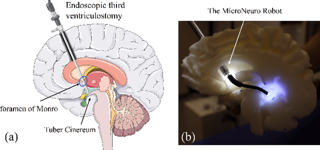 Figure 1 for Design and Visual Servoing Control of a Hybrid Dual-Segment Flexible Neurosurgical Robot for Intraventricular Biopsy