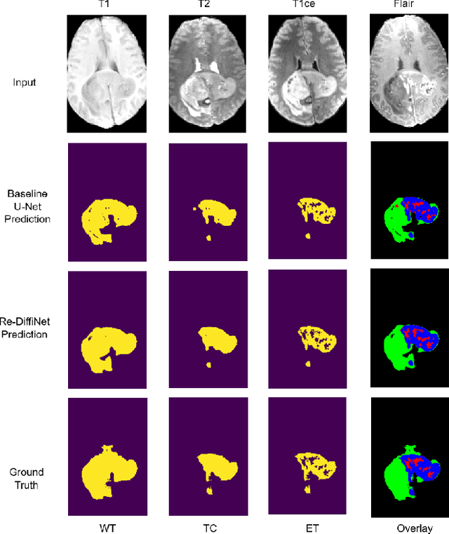 Figure 4 for Re-DiffiNet: Modeling discrepancies loss in tumor segmentation using diffusion models