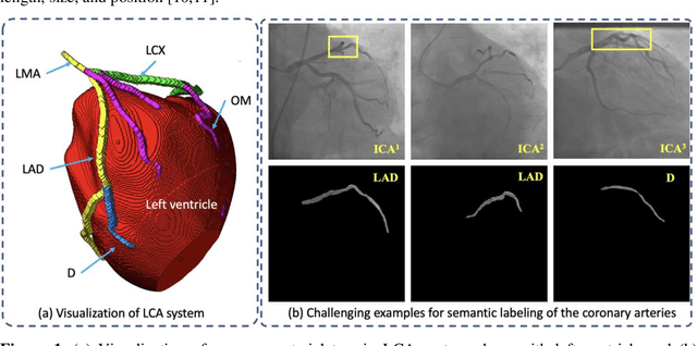 Figure 1 for AGMN: Association Graph-based Graph Matching Network for Coronary Artery Semantic Labeling on Invasive Coronary Angiograms