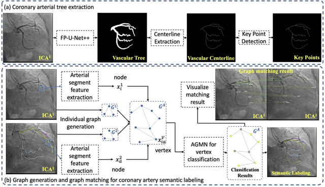 Figure 4 for AGMN: Association Graph-based Graph Matching Network for Coronary Artery Semantic Labeling on Invasive Coronary Angiograms