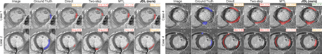 Figure 3 for Joint Deep Learning for Improved Myocardial Scar Detection from Cardiac MRI