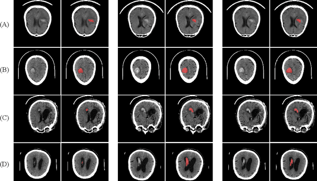 Figure 1 for HemSeg-200: A Voxel-Annotated Dataset for Intracerebral Hemorrhages Segmentation in Brain CT Scans