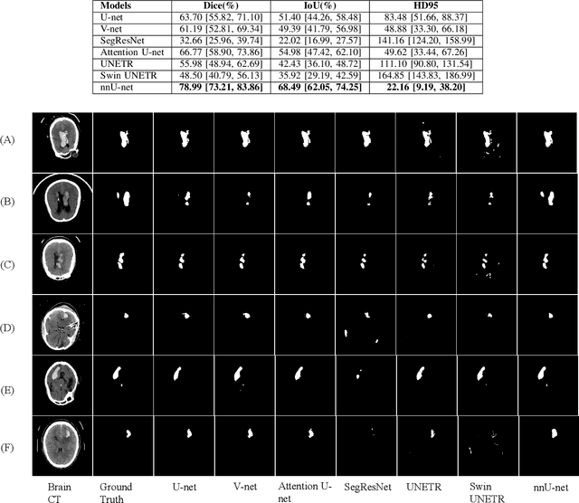 Figure 2 for HemSeg-200: A Voxel-Annotated Dataset for Intracerebral Hemorrhages Segmentation in Brain CT Scans