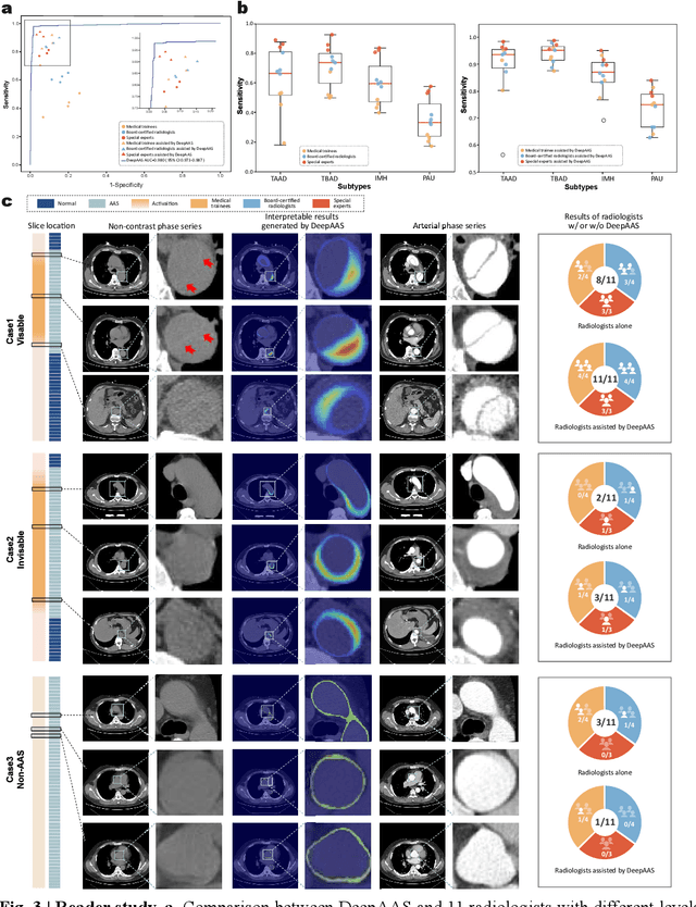 Figure 4 for Rapid and Accurate Diagnosis of Acute Aortic Syndrome using Non-contrast CT: A Large-scale, Retrospective, Multi-center and AI-based Study